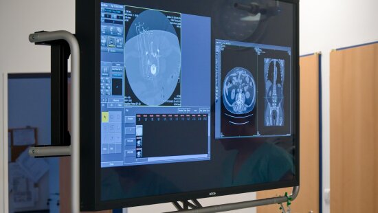 15_04_2026_elektrochemoterapie (3)